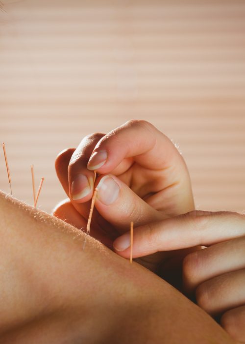 Young woman getting acupuncture treatment in therapy room